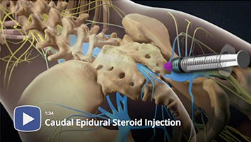 Transforaminal steroid injections