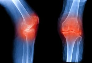 Osteoarthritis