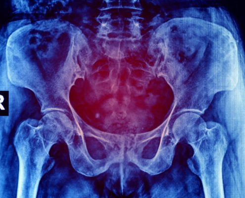 Pelvic Pain