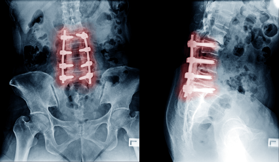 Degenerative Disc Disease Treatment