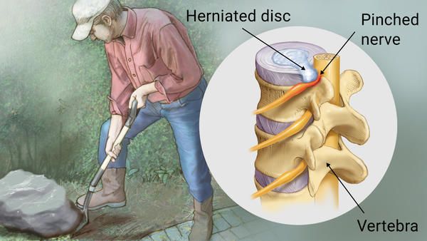 Herniated Disc